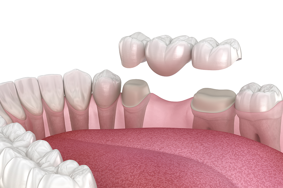Dental Crowns vs Bridges Explained by a Boca Raton Dentist